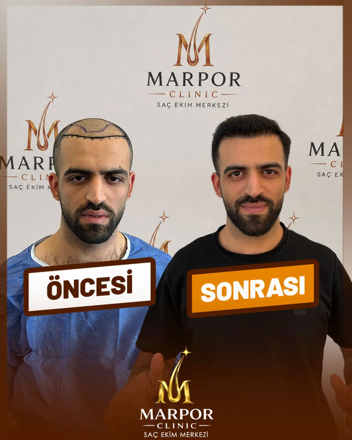 Saç ekimi öncesi ve sonrası - Hasta 5
