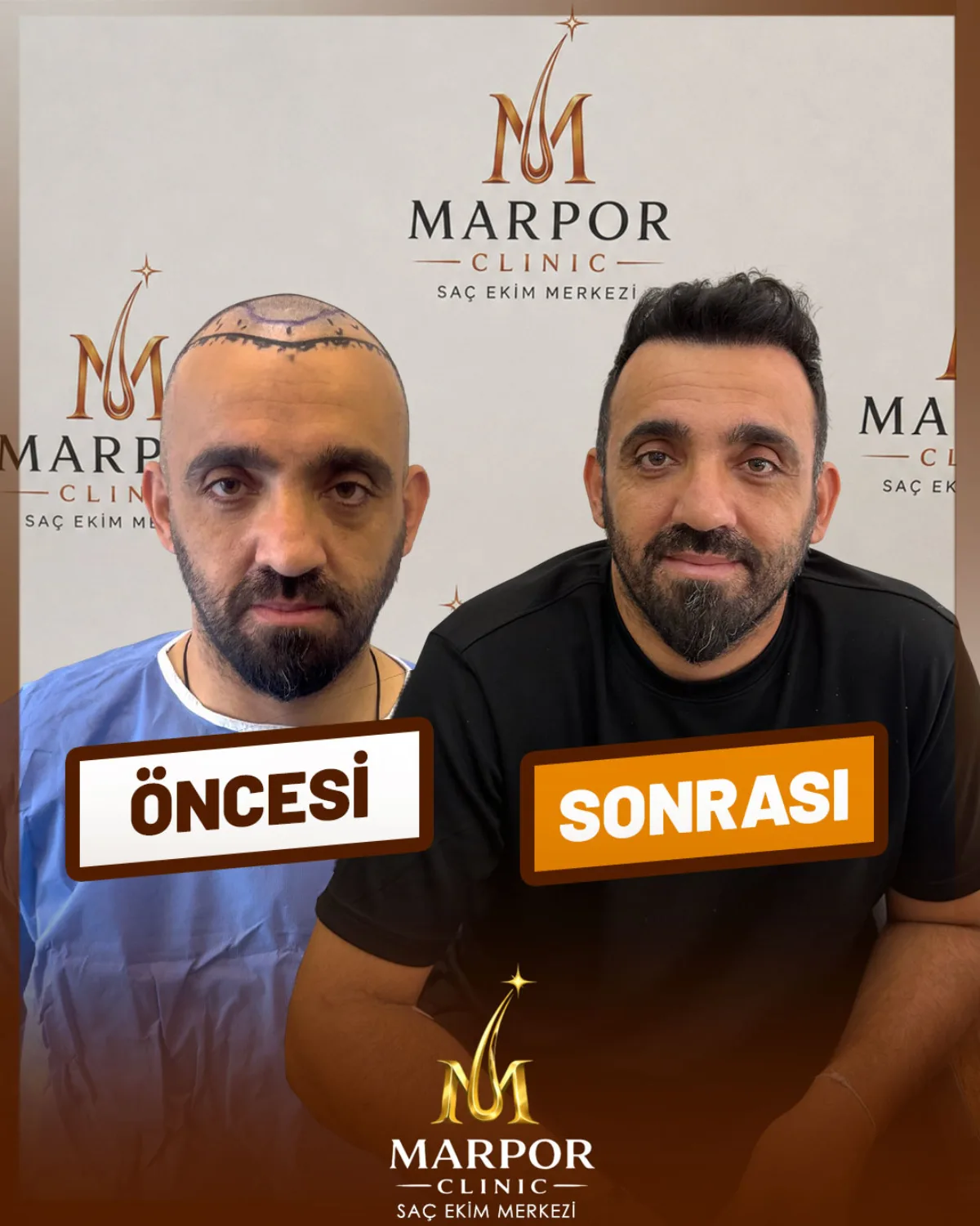 Saç ekimi öncesi ve sonrası - Hasta 7