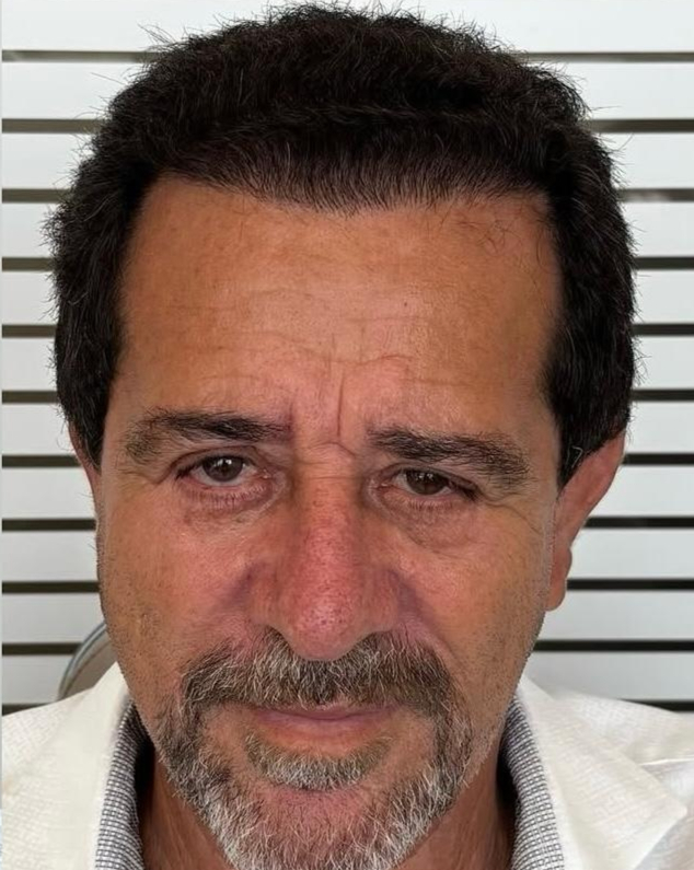 Müşteri 1 - Saç ekimi sonrası