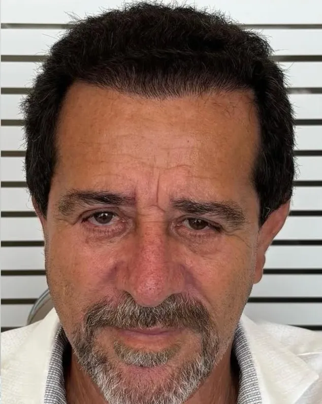 Müşteri 1 - Saç ekimi sonrası